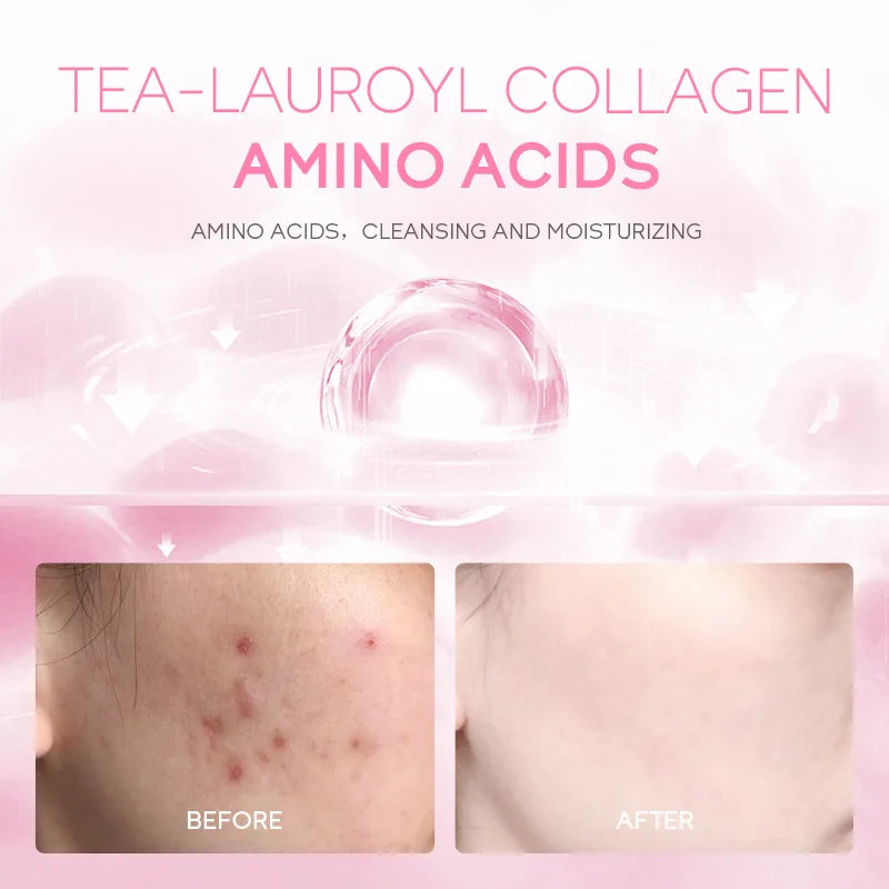 Facial Cleanser Moisturizing Acne Removal